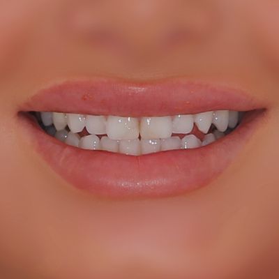 Composite Bonding - Smile 14 before
